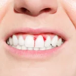 How To Reverse Periodontal Disease Naturally