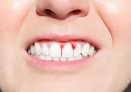 How To Reverse Periodontal Disease Naturally