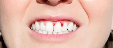 How To Reverse Periodontal Disease Naturally